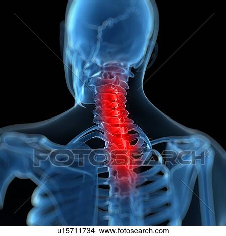 Back pain, conceptual artwork View Large Illustration Stock Illustration - Back pain, conceptual artwork. Fotosearch