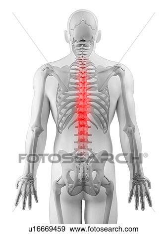 Stock Illustration - Back pain, conceptual artwork. Fotosearch