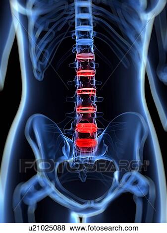 Stock Illustration - Back pain, conceptual artwork. Fotosearch