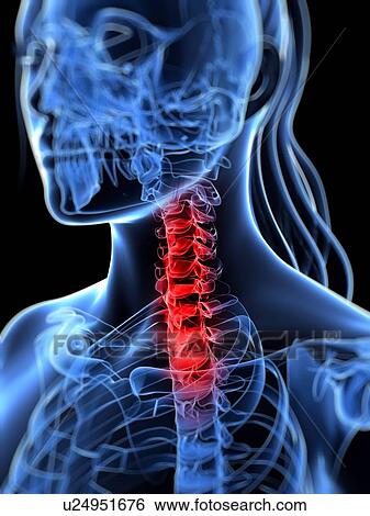 Stock Illustration - Back pain, conceptual artwork. Fotosearch