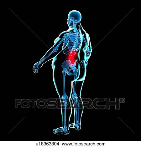 Stock Illustration - Back pain in obesity, conceptual artwork. Fotosearch