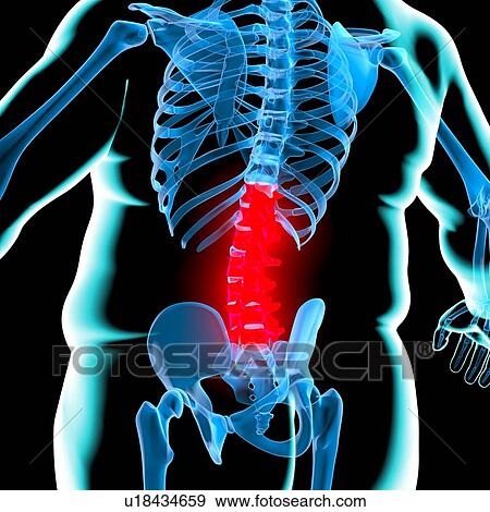 Stock Illustration - Back pain in obesity, conceptual artwork. Fotosearch