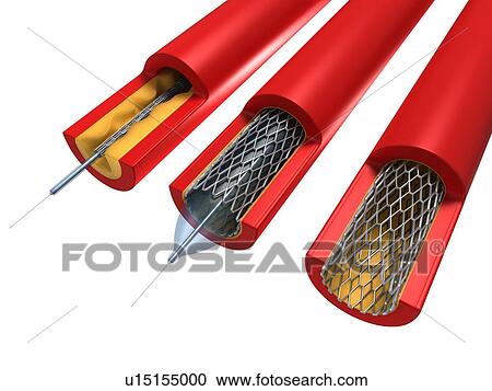 Clipart - Balloon angioplasty, artwork. Fotosearch