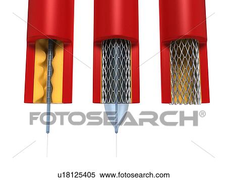 Stock Illustration - Balloon angioplasty, artwork. Fotosearch