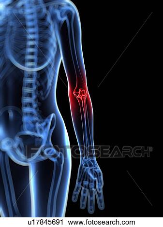 Elbow pain, conceptual artwork View Large Illustration Clip Art - Elbow pain, conceptual artwork. Fotosearch