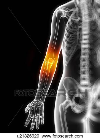 Elbow pain, conceptual artwork View Large Illustration Clipart - Elbow pain, conceptual artwork. Fotosearch