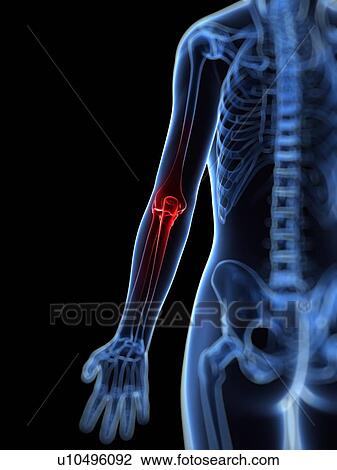 Drawing - Elbow pain, conceptual artwork. Fotosearch