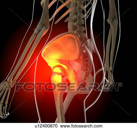 Clipart - Hip pain, conceptual artwork. Fotosearch
