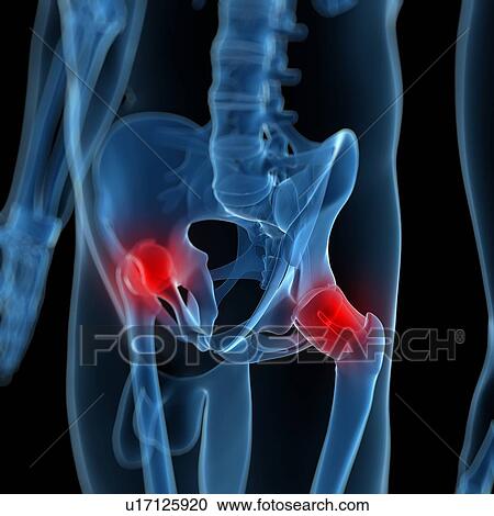 Clipart - Hip pain, conceptual artwork. Fotosearch