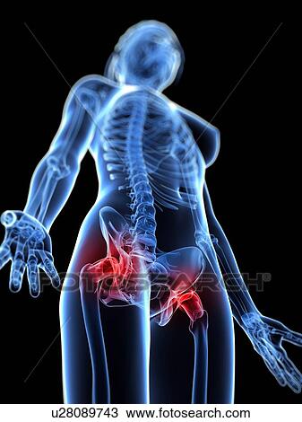 Drawing - Hip pain, conceptual artwork. Fotosearch