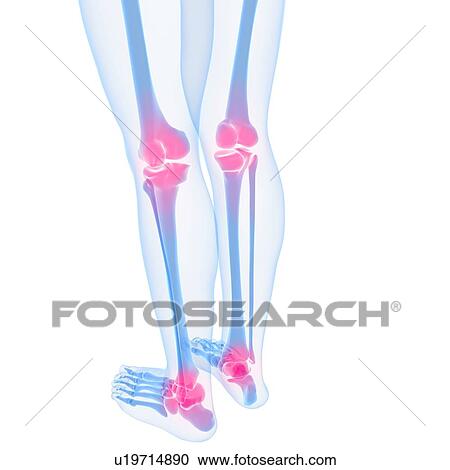 Clipart - Joint pain, conceptual artwork. Fotosearch