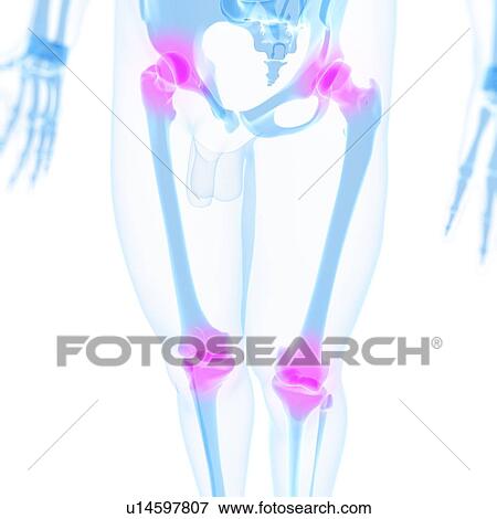 Joint pain, conceptual artwork View Large Illustration Stock Illustration - Joint pain, conceptual artwork. Fotosearch