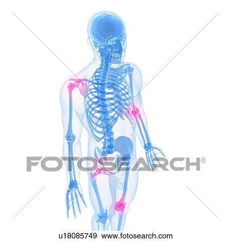 Stock Illustration - Joint pain, conceptual artwork. Fotosearch