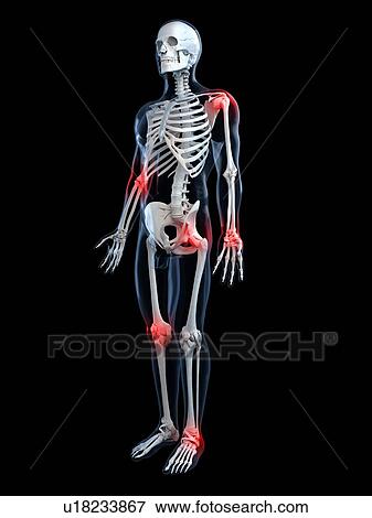 Stock Illustration - Joint pain, conceptual artwork. Fotosearch