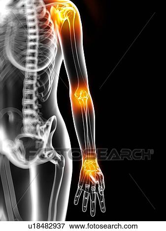 Stock Illustration - Joint pain, conceptual artwork. Fotosearch