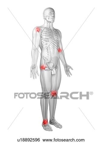 Stock Illustration - Joint pain, conceptual artwork. Fotosearch