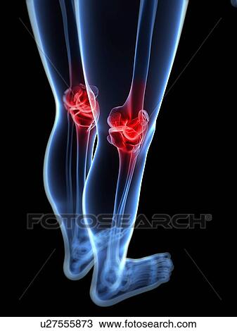 Knee pain, conceptual artwork View Large Illustration Drawing - Knee pain, conceptual artwork. Fotosearch