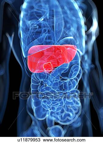 Liver cancer, artwork View Large Illustration Drawing - Liver cancer, artwork. Fotosearch