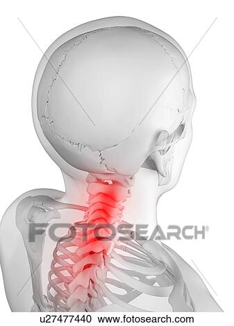 Neck pain, conceptual artwork View Large Illustration Clipart - Neck pain, conceptual artwork. Fotosearch