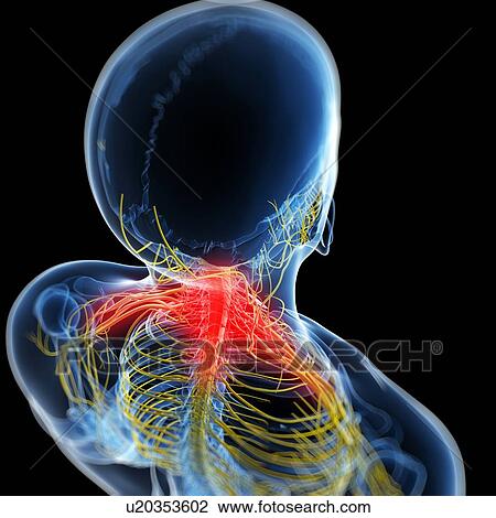 Drawing - Neck pain, conceptual artwork. Fotosearch