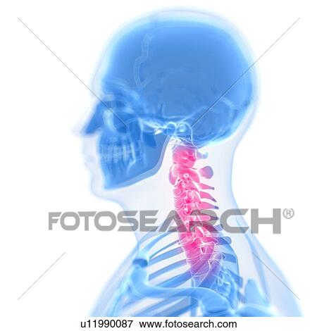 Stock Illustration - Neck pain, conceptual artwork. Fotosearch