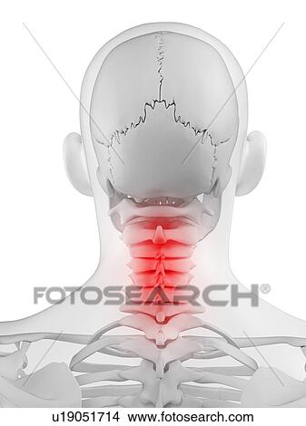 Stock Illustration - Neck pain, conceptual artwork. Fotosearch