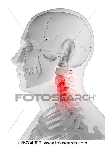 Stock Illustration - Neck pain, conceptual artwork. Fotosearch
