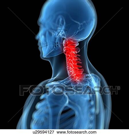 Neck pain, conceptual artwork View Large Illustration Stock Illustration - Neck pain, conceptual artwork. Fotosearch
