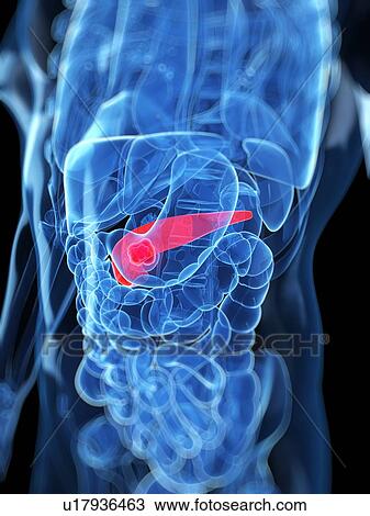Pancreatic cancer, artwork View Large Illustration Drawing - Pancreatic cancer, artwork. Fotosearch