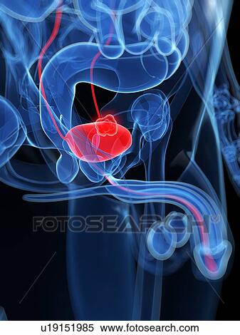Prostate cancer, artwork View Large Illustration Stock Illustration - Prostate cancer, artwork. Fotosearch