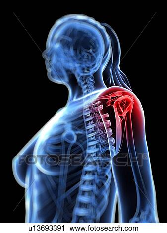 Clip Art - Shoulder pain, conceptual artwork. Fotosearch
