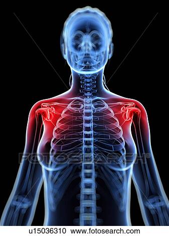 Clipart - Shoulder pain, conceptual artwork. Fotosearch