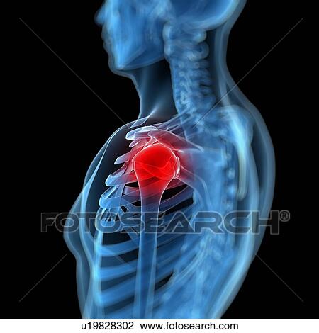 Shoulder pain, conceptual artwork View Large Illustration Drawing - Shoulder pain, conceptual artwork. Fotosearch