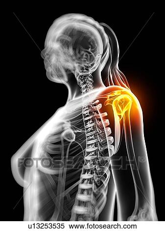 Shoulder pain, conceptual artwork View Large Illustration Stock Illustration - Shoulder pain, conceptual artwork. Fotosearch