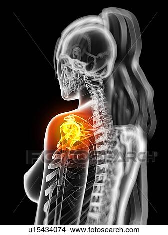 Shoulder pain, conceptual artwork View Large Illustration Stock Illustration - Shoulder pain, conceptual artwork. Fotosearch