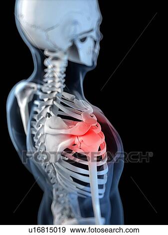 Shoulder pain, conceptual artwork View Large Illustration Stock Illustration - Shoulder pain, conceptual artwork. Fotosearch