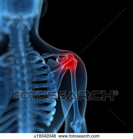 Stock Illustration - Shoulder pain, conceptual artwork. Fotosearch
