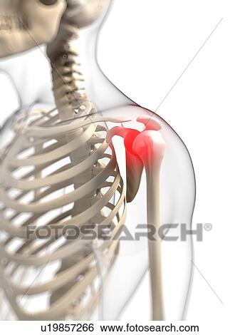 Stock Illustration - Shoulder pain, conceptual artwork. Fotosearch
