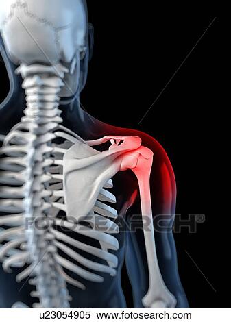 Shoulder pain, conceptual artwork View Large Illustration Stock Illustration - Shoulder pain, conceptual artwork. Fotosearch