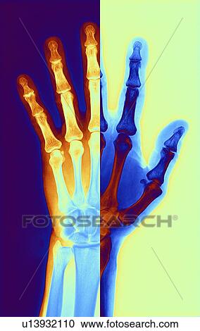 Clipart - Arthritic hand, X-ray. Fotosearch