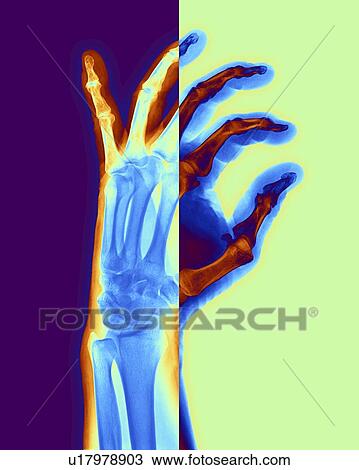 Arthritic hand, X-ray View Large Illustration Drawing - Arthritic hand, X-ray. Fotosearch