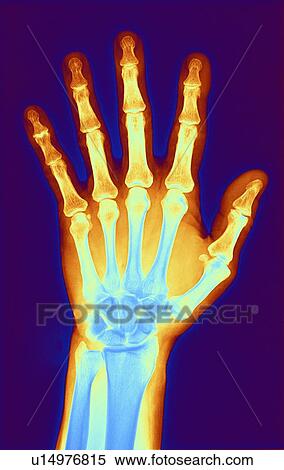 Arthritic hand, X-ray View Large Illustration Stock Illustration - Arthritic hand, X-ray. Fotosearch