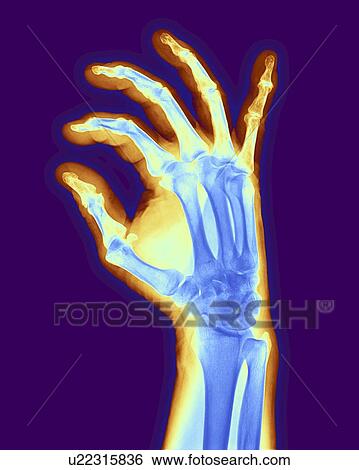 Stock Illustration - Arthritic hand, X-ray. Fotosearch