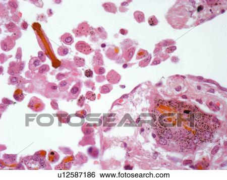 Asbestos in lung tissue, light micrograph View Large Illustration Stock Illustration - Asbestos in lung tissue, light micrograph. Fotosearch