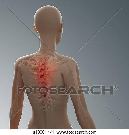 Clip Art - Back pain, conceptual artwork. Fotosearch