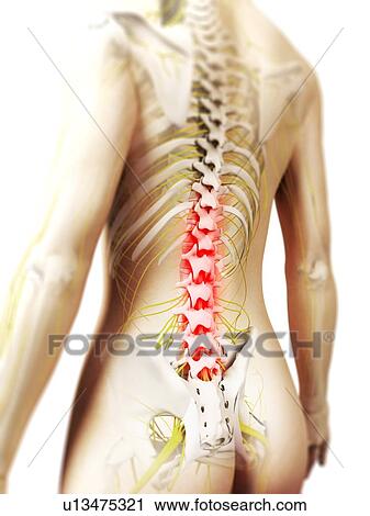 Clip Art - Back pain, conceptual artwork. Fotosearch