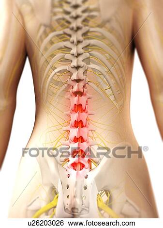 Back pain, conceptual artwork View Large Illustration Stock Illustration - Back pain, conceptual artwork. Fotosearch