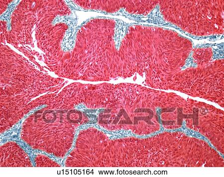 Stock Illustration - Bladder cancer, light micrograph. Fotosearch
