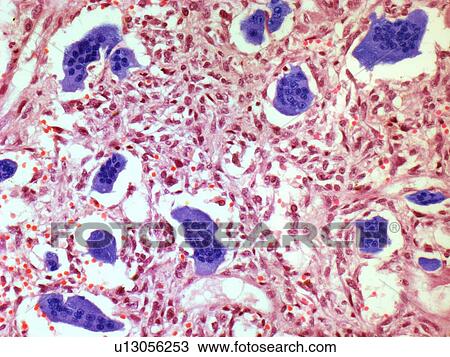 Drawing - Bone tumour, light micrograph. Fotosearch