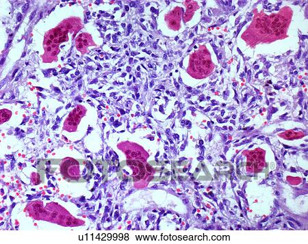 Bone tumour, light micrograph View Large Illustration Stock Illustration - Bone tumour, light micrograph. Fotosearch